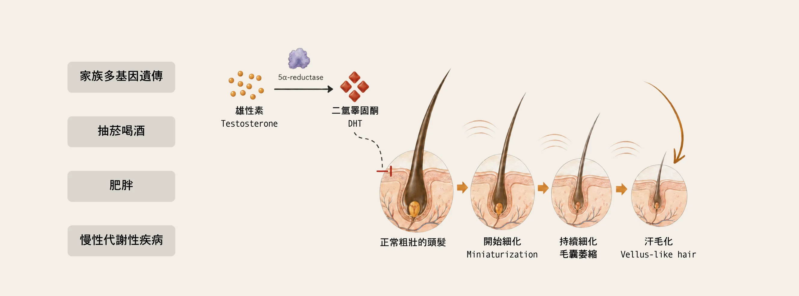 毛囊微小化示意圖:睪固酮經 5α-reductase 轉化為 DHT 後造成毛囊逐漸萎縮